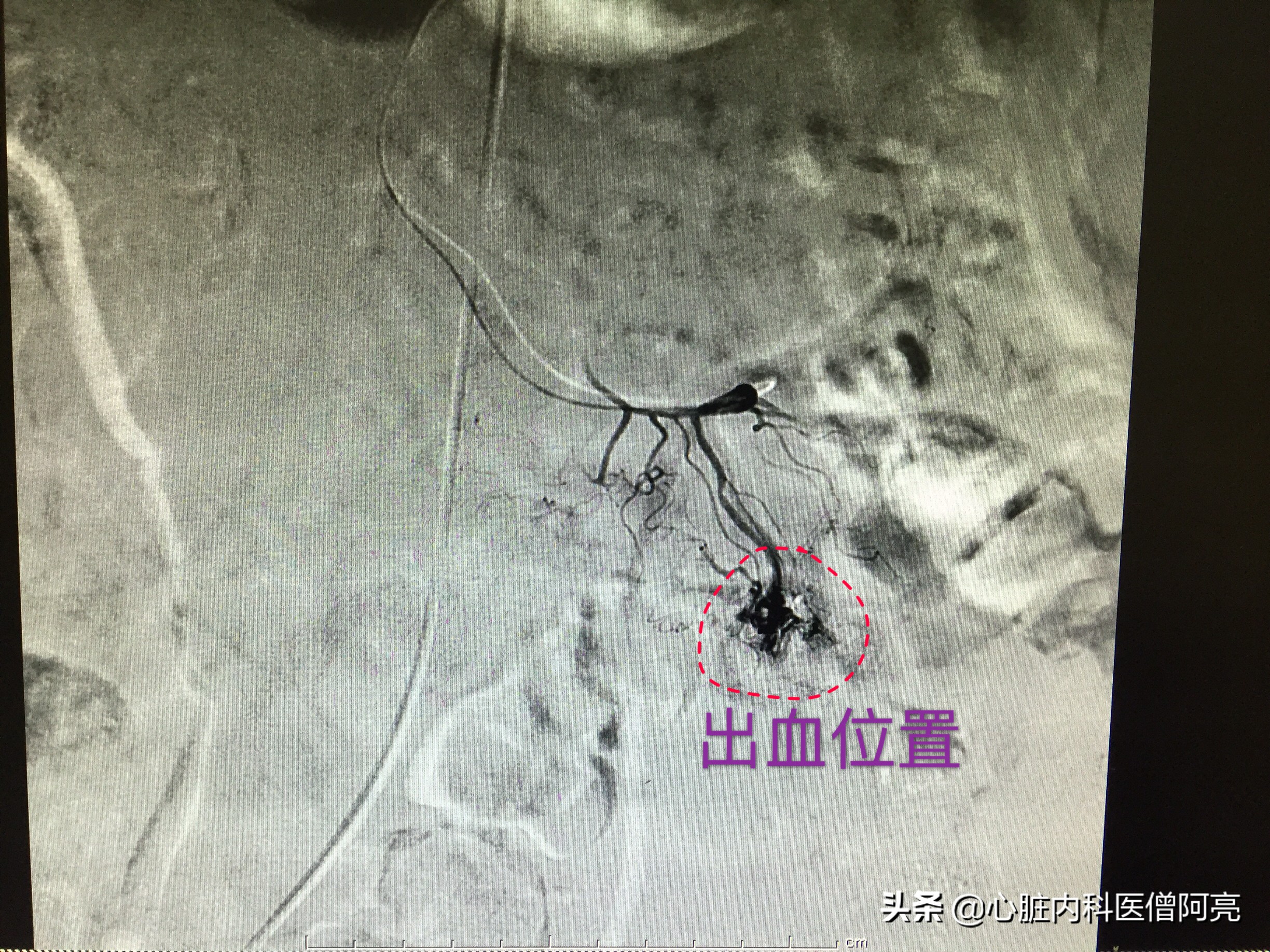 支架后消化道出血可治愈么,心脏支架手术后胃肠道出血怎么办