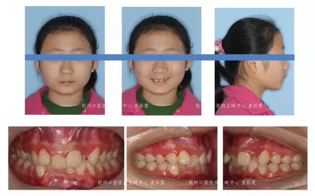 牙齿深覆合对脸型的影响,覆合型牙齿是怎么造成的