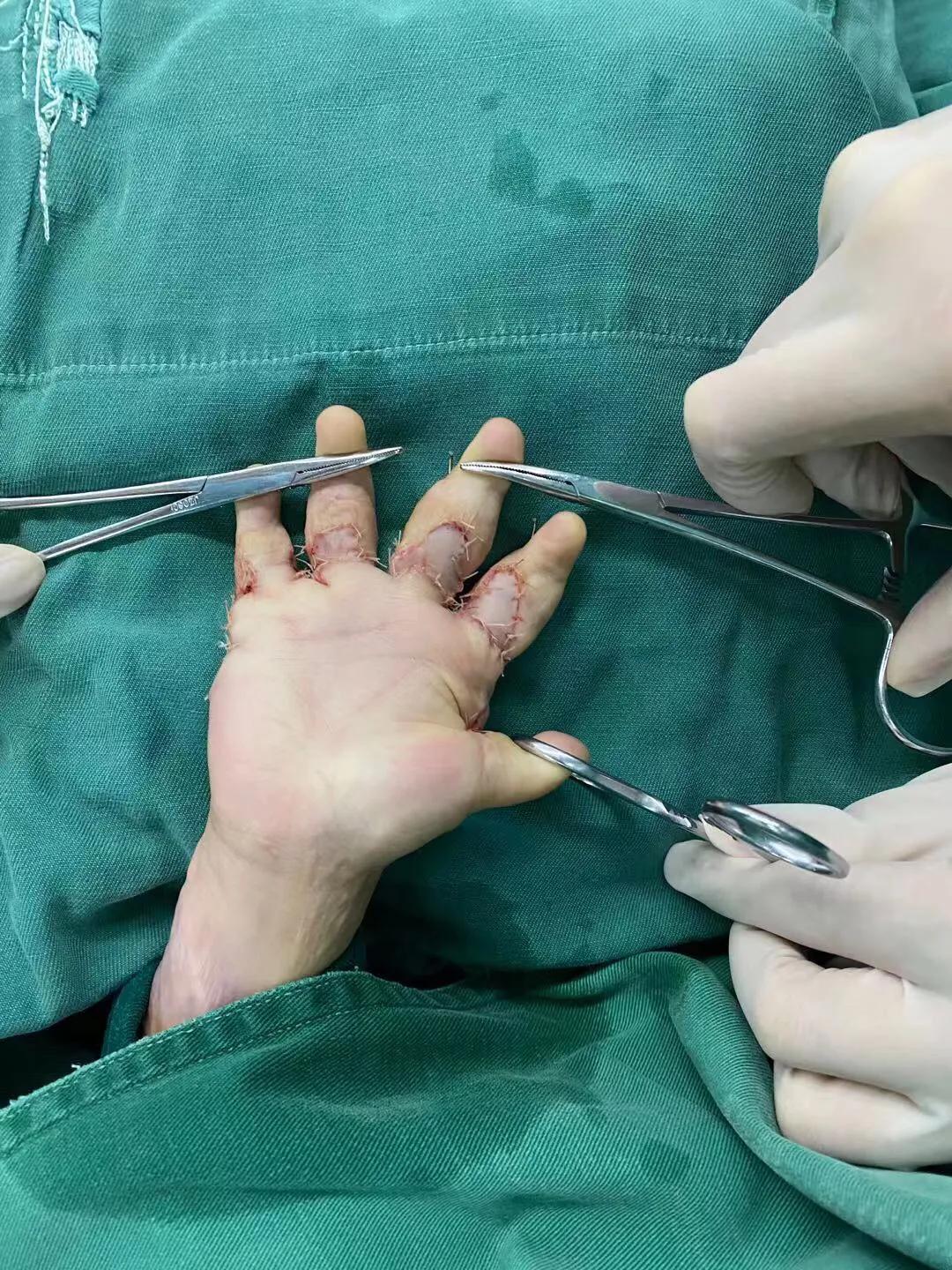 儿童烫伤的疤痕,三度烫伤疤痕为啥挛缩