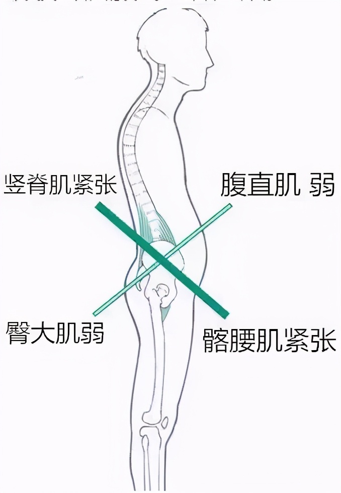 怎么缓解屁股和腰痛,练臀肌有利于缓解腰痛吗