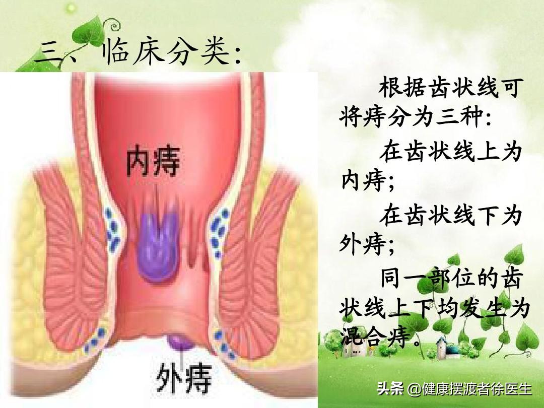 解血便,解便时发现有血怎么回事