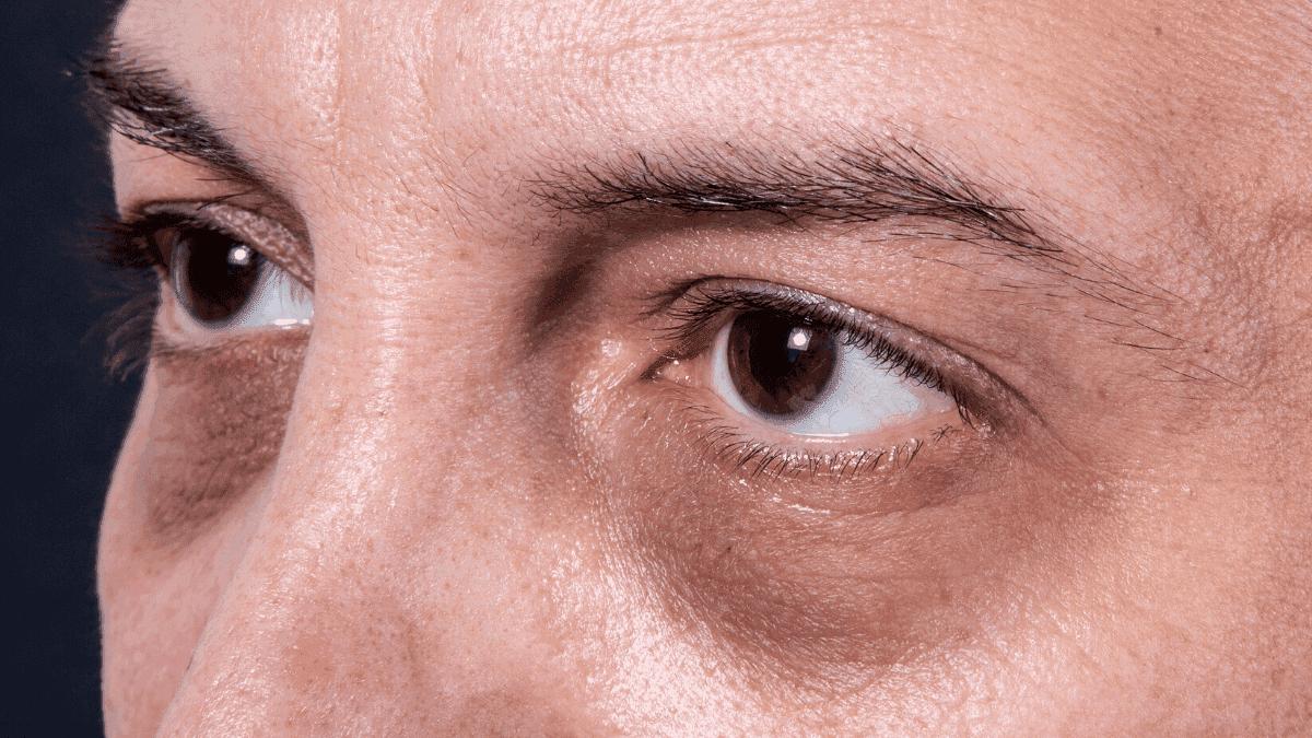 眼部有细纹用眼膜有用吗,眼部细纹眼膜有用吗