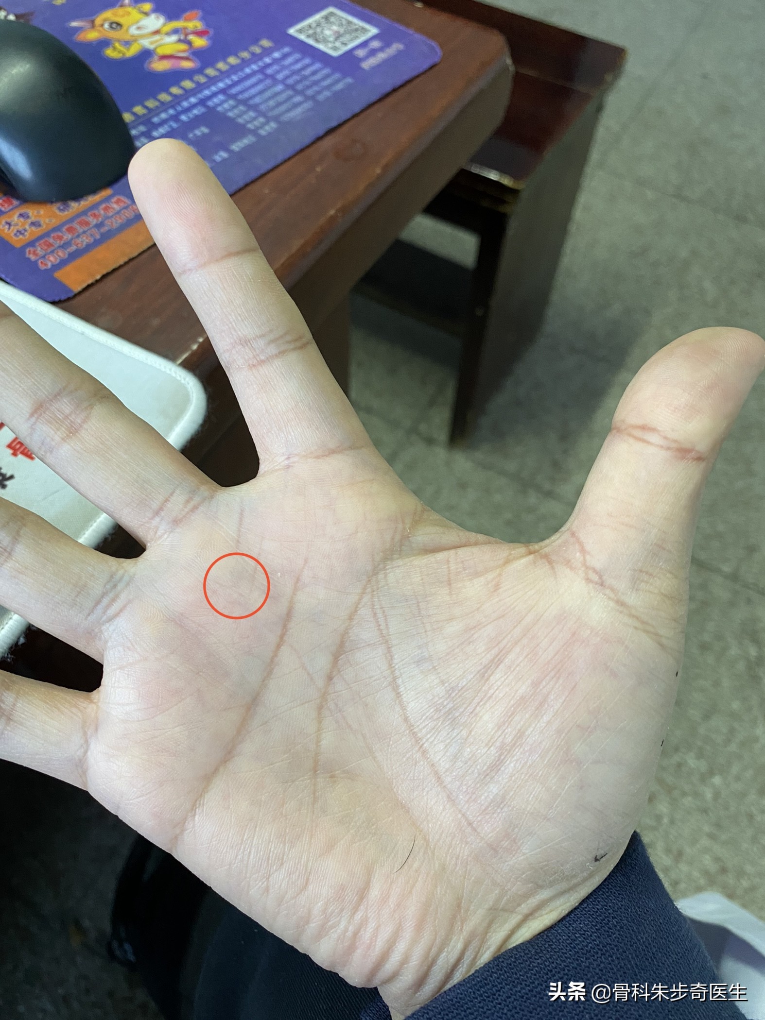 患者故事：今天说说，腱鞘炎究竟应该怎么治疗？需要不需要手术？