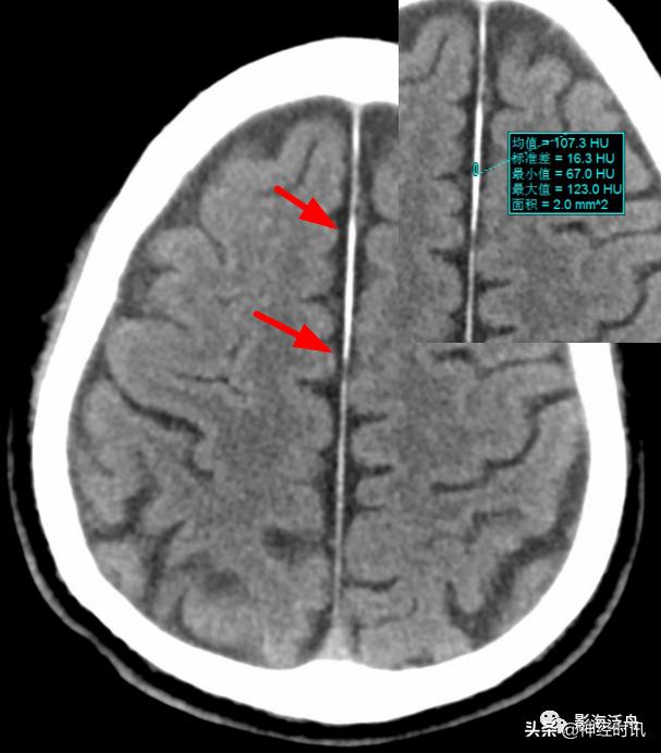 蛛血的临床表现,蛛血ct表现