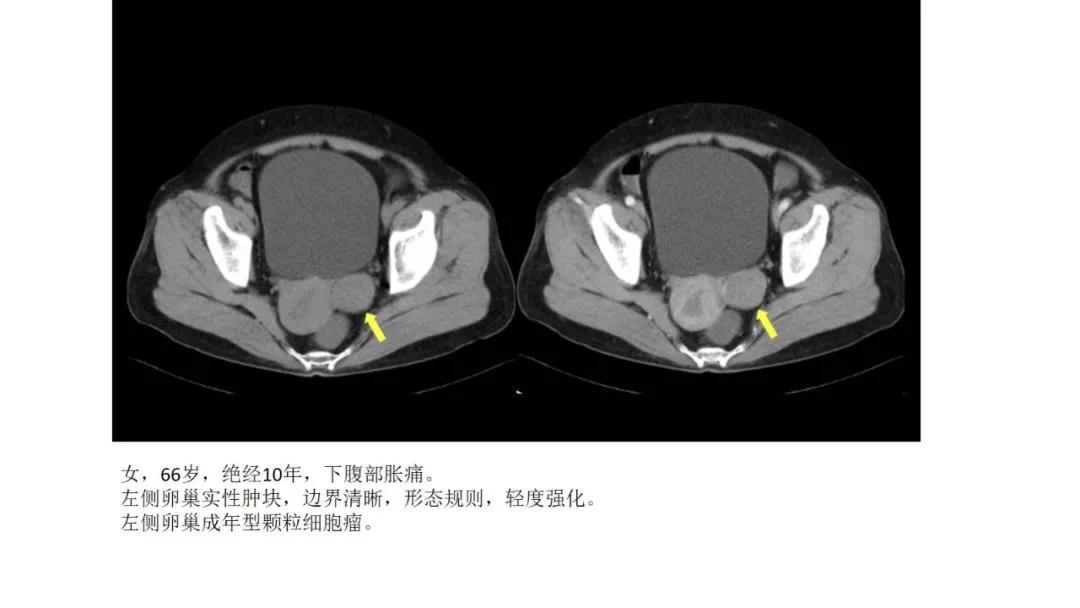 卵巢原发肿瘤的分析思路