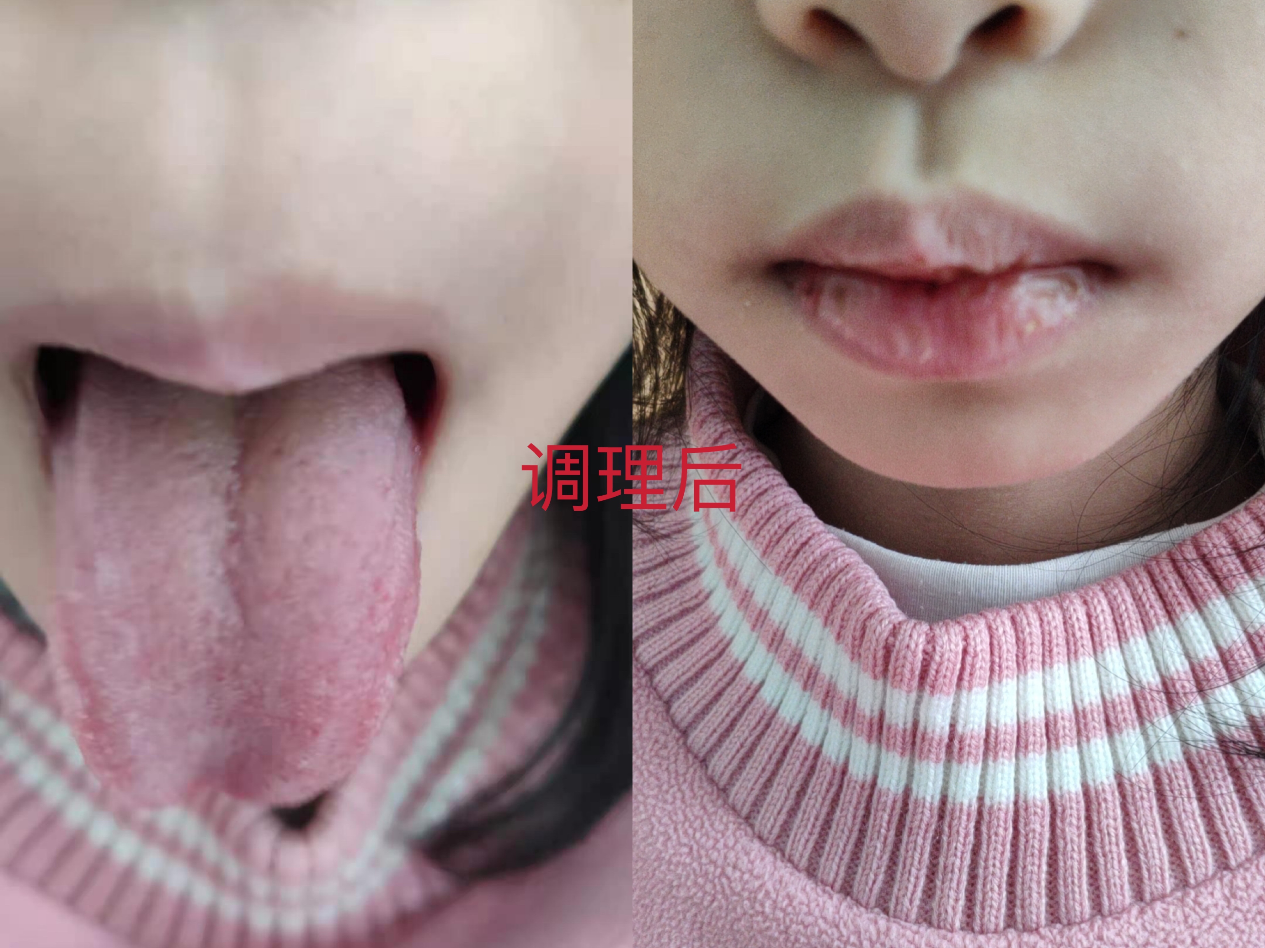 小儿积食发热中医解决方法,积食发热的中医治疗