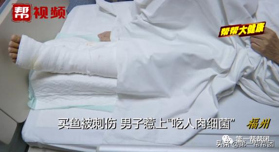 买鱼被鱼刺中截肢,手指被鲈鱼鳍扎伤