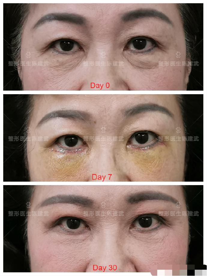 去眼袋泪沟医美方法,想了解一下去眼袋的最佳方法