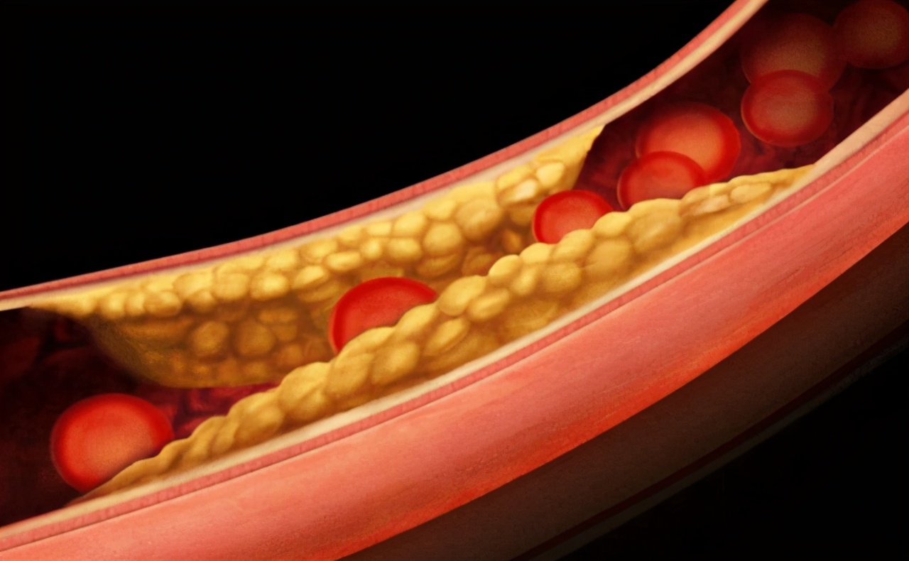 40以后女子每天一粒叶酸的利弊,52岁女子每天吃一片叶酸防脑梗
