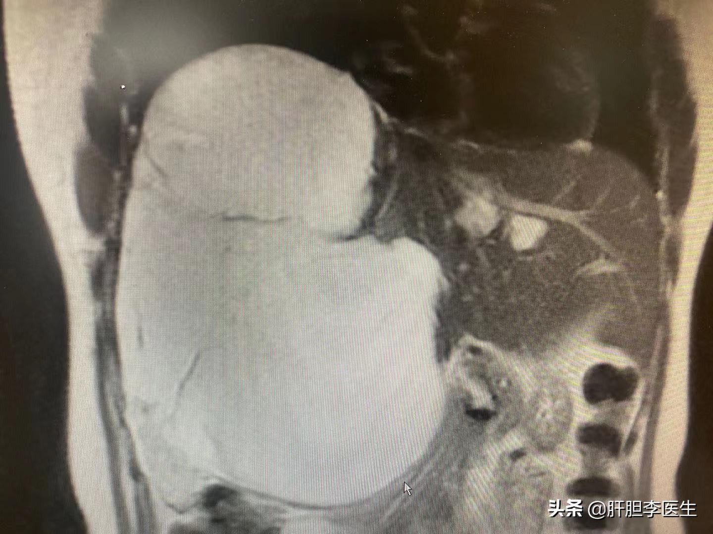 肝血管瘤3x2.5cm严重吗,体检发现肝血管瘤20*14mm