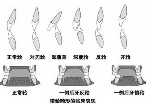云南牙齿隐形矫正,南通隐形牙套矫正的全过程