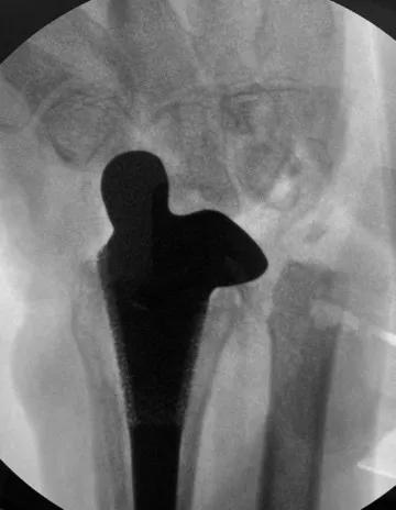 腕关节置换最新技术,踝关节3D打印置换术视频