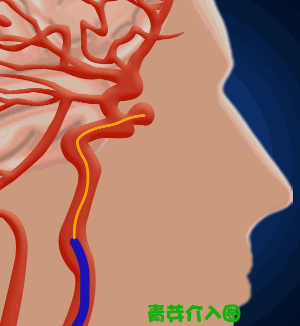 颅内动脉瘤介入栓塞支架全过程,颅内夹层动脉瘤介入演示