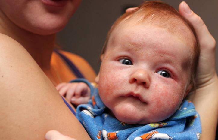 新生儿额头湿疹怎么消除又快又好,额头上湿疹黑斑要多长时间能消除