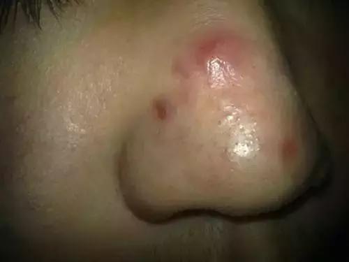 脸上有螨虫的10个征兆,脸上有螨虫的人要注意了