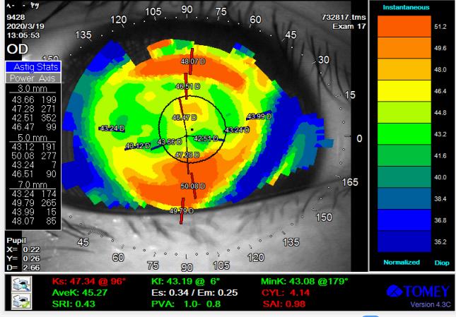 角膜散光大者一定不能配戴角膜塑形镜么？