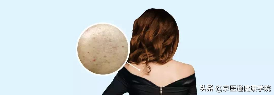 顽固湿疹痘痘,痘痘湿疹肌肤怎么改善