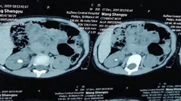 小儿尿道结石如何碎石,小儿尿结石