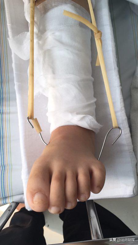 交通事故小腿胫骨骨折做手术,常德市第一中医医院骨伤科