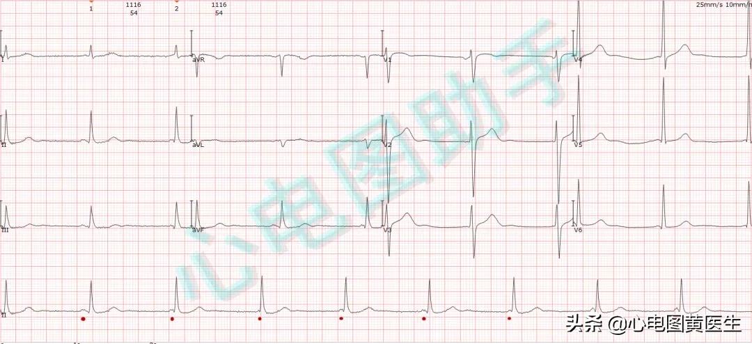 三度房室传导阻滞，房室干扰性脱节，怎么看？
