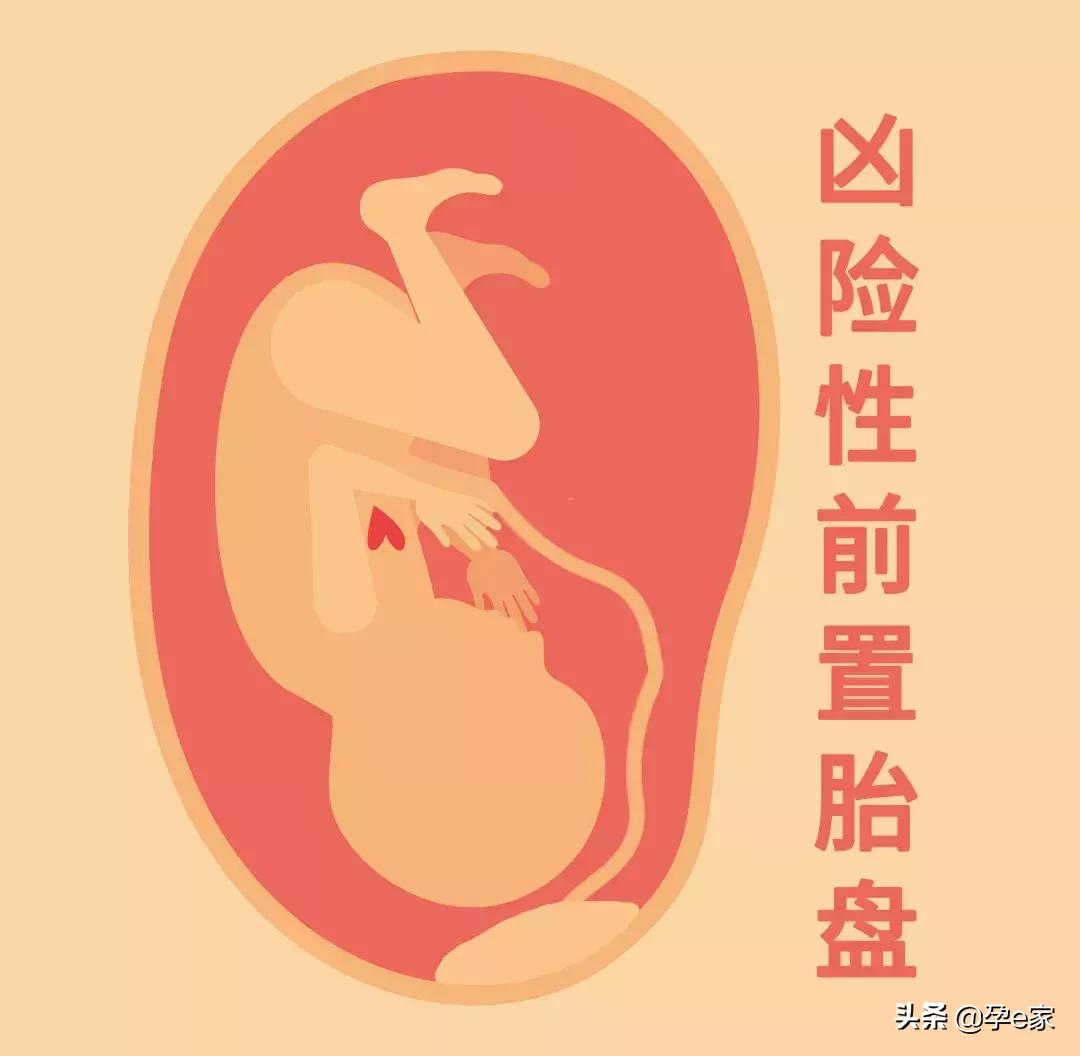 剖宫产一次比一次痛,剖宫产受罪为什么还有人剖