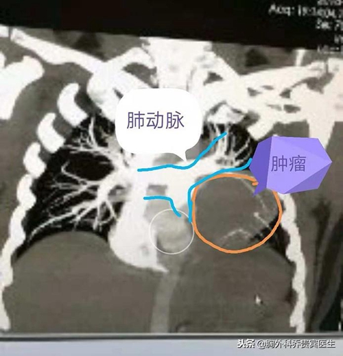 年纪大的恶性胸腺瘤建议做手术吗,30多岁胸腺瘤影响生命