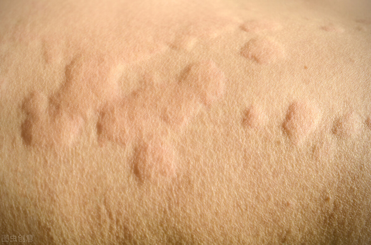 得了10几年荨麻疹,得了荨麻疹吃了10天药为啥还是痒