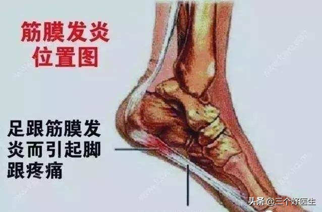 足底筋膜炎痛的说说,关于足底疼痛