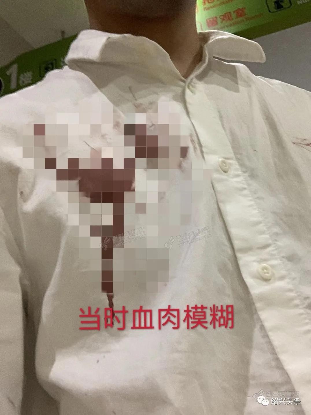 绍兴13个月宝宝在商场割断手指筋，现场血肉模糊，急送省儿保