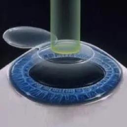 术前必须做的检查项目,近视手术的几种方式优缺点对比图