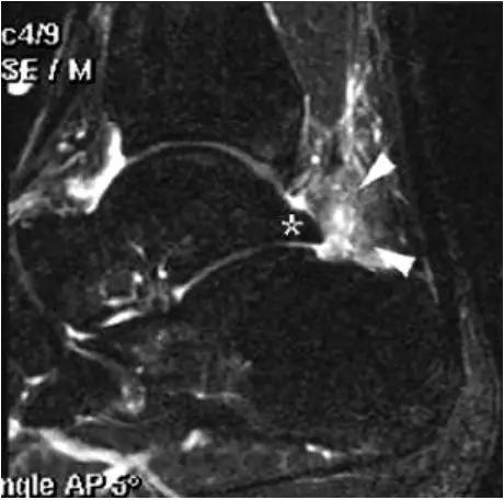 踝关节撞击症问诊,踝关节内侧撞击综合症位置图