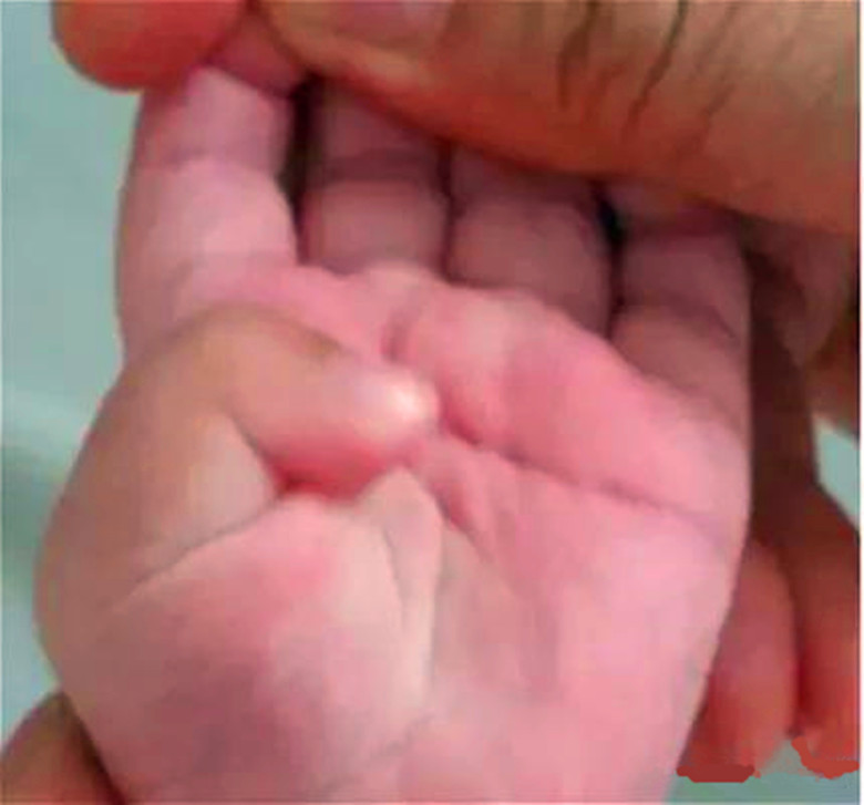 宝宝拇指内扣是一直内扣吗,一般几个月婴儿拇指内扣是正常