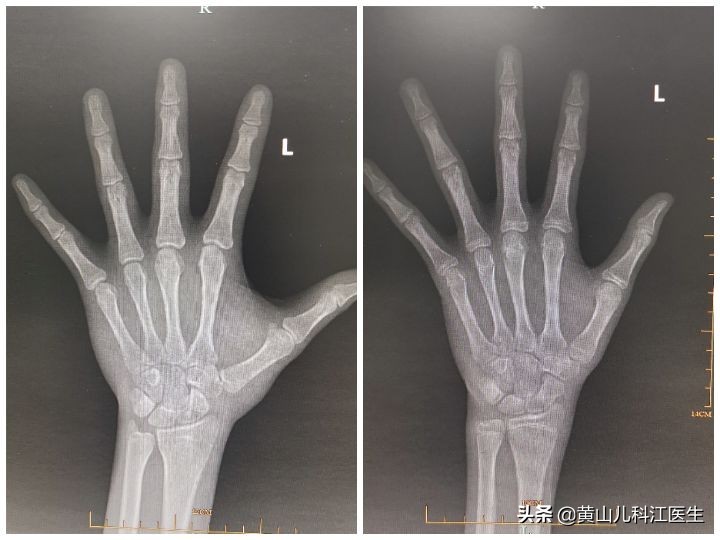 暑假怎样帮助孩子长高,如何让孩子在暑假之内快速长高