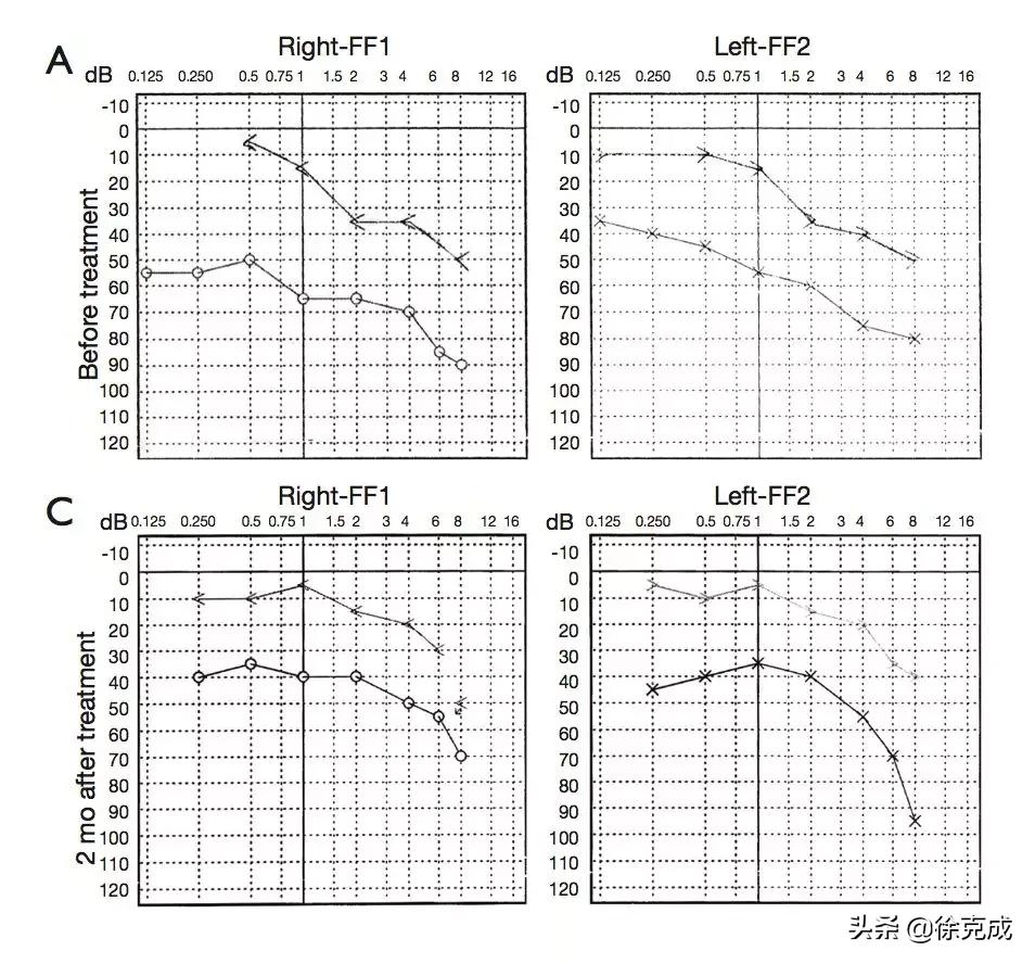 鼻咽癌放疗对大脑的影响,鼻咽癌放疗后眩晕