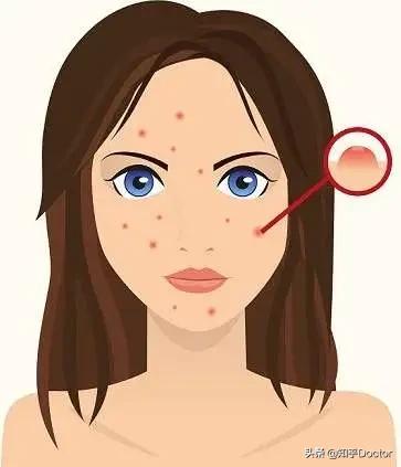 *疮痤**和毛囊炎完全不是一种病，正确区别，不可一概而论