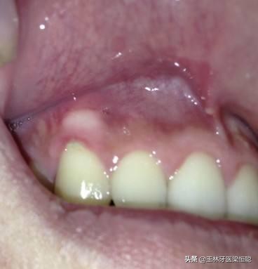 张口呼吸会导致牙槽骨突出吗,牙槽骨突起来了怎么办