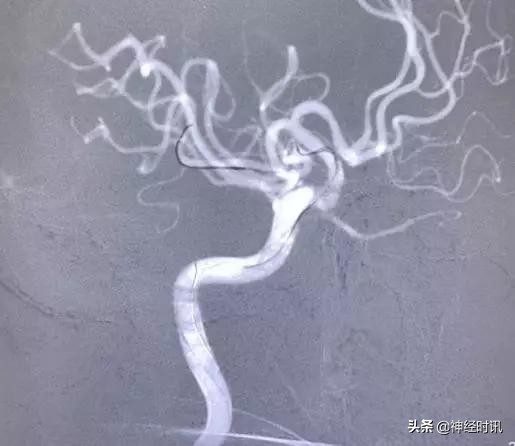 脑血管病介入治疗的介绍,缺血性脑血管病介入治疗进展2015