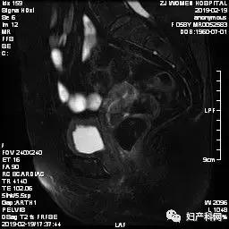 子宫异常出血的病理解剖诊断,产科大出血典型病例分析