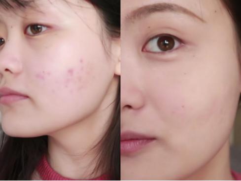 美摩仕祛痘膏效果好吗,美摩仕祛痘效果好吗