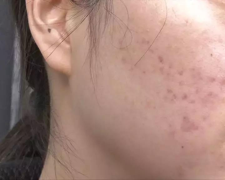 一次美容后她脸烂了！无锡这位女士在整形医院经历了什么……