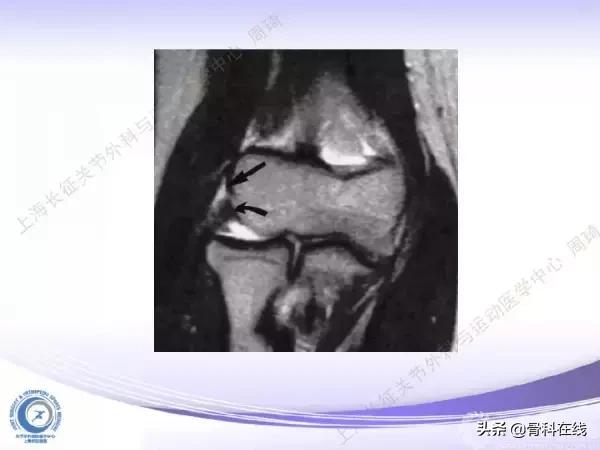 肘关节镜手术后引流,肘关节镜微创手术