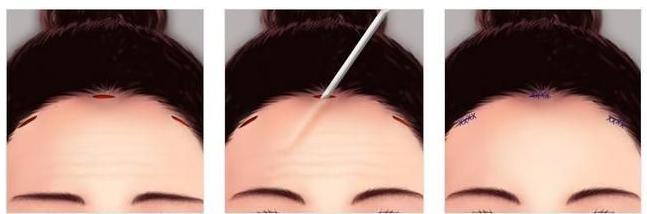 除皱方法大揭秘顺利抚平皱纹,除皱抗皱有什么好的方法