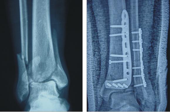 跖跗关节脱位骨折案例,粗隆间骨折个案