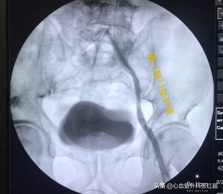 外周血管外科治疗范围,外周血管介入治疗疗程