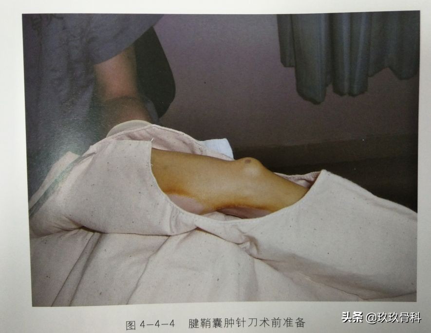 腱鞘囊肿针刺技巧视频,手指腱鞘囊肿正确挤压方法视频