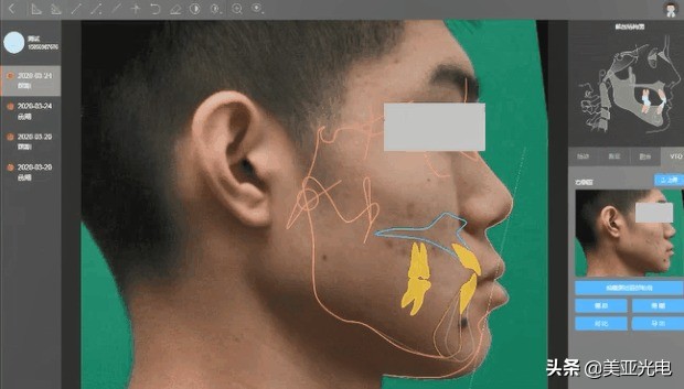 美亚口腔cbct全新局部ct功能上线,口腔cbct最好的品牌