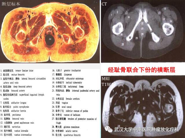 女性盆腔解剖与断层影像