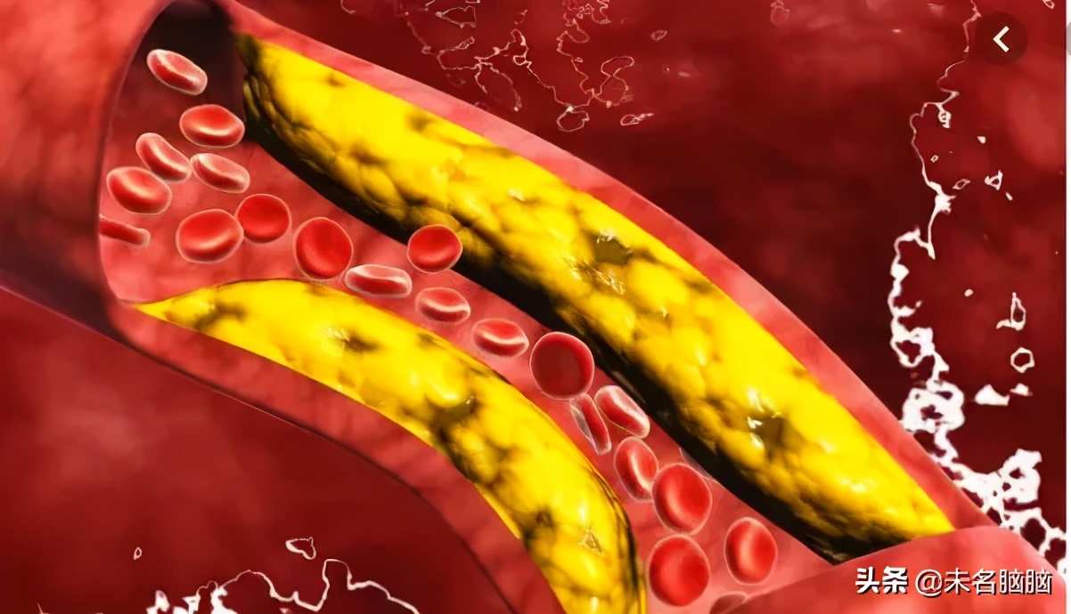 哪些是阿尔茨海默症的风险因素,老年性痴呆阿尔茨海默病病例