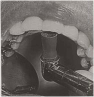 多图直击！牙医如何用抛光把孩子的牙洗干净？#葉子口腔科普#