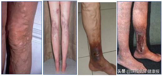 下肢静脉性溃疡伤口护理,关于下肢静脉性溃疡伤口图片